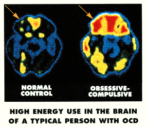 http://www.hope4ocd.com/graphics/petscan1.gif