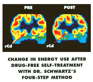 Pet Scan